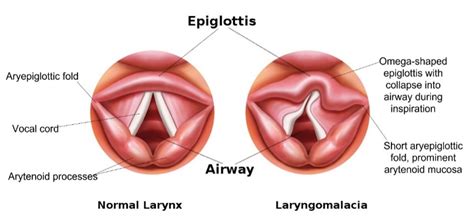 Laryngomalacia | Stridor | Geeky Medics