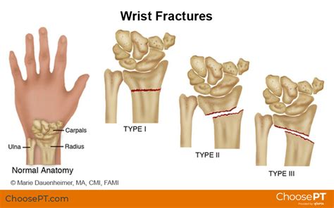 Guide | Physical Therapy Guide to Wrist Fracture | Choose PT