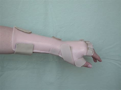 Radial Nerve Palsy splint (Pulvertaft). Great low profile splint which ...