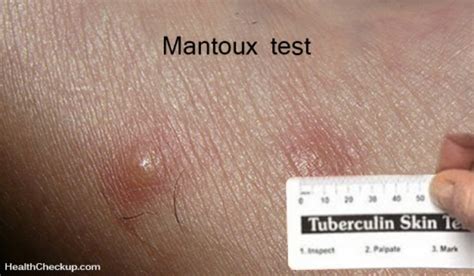 Mantoux Skin Test Procedure, Results Interpretation, Risks