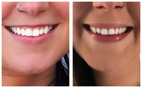 LIP FLIP: What Is It & Why Are People Choosing It Over Lip Filler?