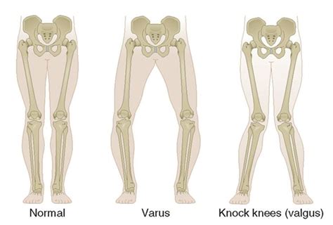 Knieprothese voor artrose van de knie - Orthopedie Roeselare