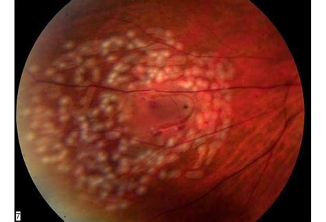 Medical Treatment Pictures-for Better Understanding: Retinal Laser ...