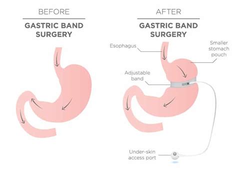 Lap Band Removal | Weight Loss Surgery Revision | Seattle, WA