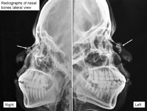 Nasal Bone X Ray Positioning