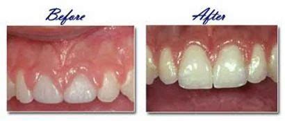 Gingivoplasty Surgery in Mangalore | ID: 7188452230