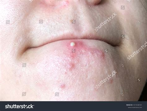 Acne Multiple Acne Scars Chin Stock Photo 1015538191 | Shutterstock