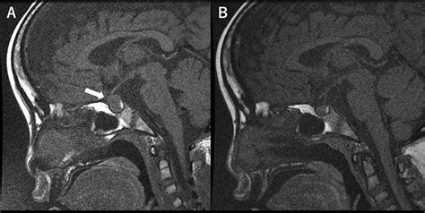 Pituitary hyperplasia in a girl with primary hypothyroidism | BMJ Case ...