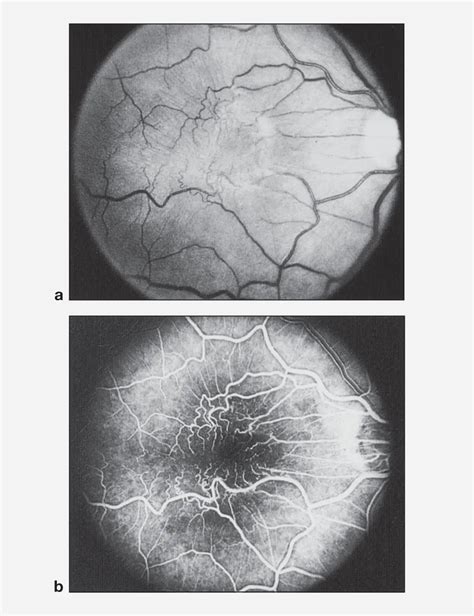 Epiretinal membrane - American Academy of Ophthalmology