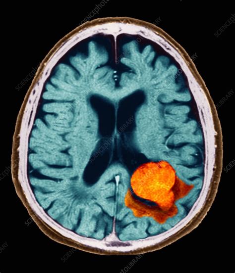 Lesion On Brain Scan