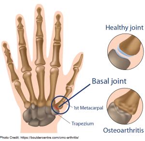 Painful Thumb? How to Rehab Your Thumb Osteoarthritis? - REHAB FOR A ...