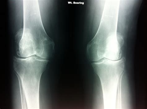 Bilateral knee osteoarthritis x-ray AP – Podiatrist Brisbane Southside ...