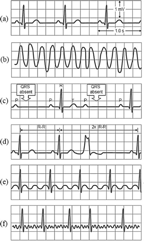 Common examples of abnormal ECGs [11]; (a) Normal Sinus Rhythm; (b ...