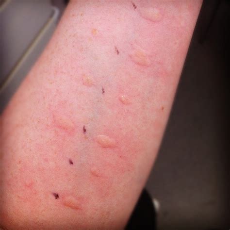 Allergy testing! I'm getting some pretty amazing welts thi… | Flickr