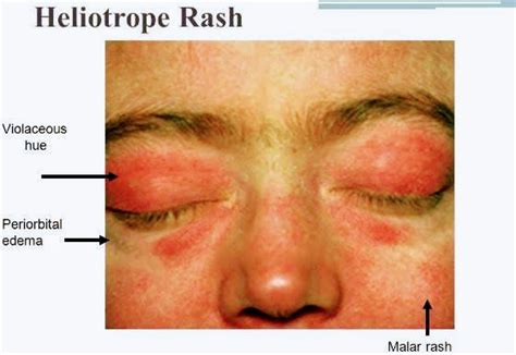 Symptoms of Dermatomyositis - PT Master Guide