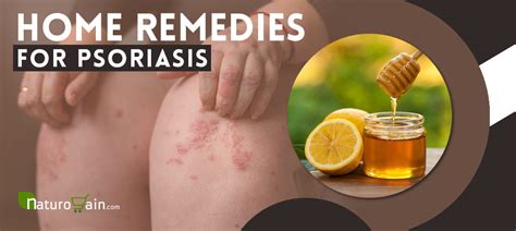 10 Best Home Remedies for Psoriasis That You Need to Know