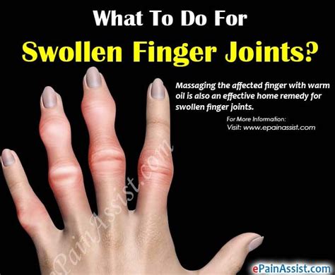 How To Tell If Your Hands Are Swollen - Margaret Greene Kapsels