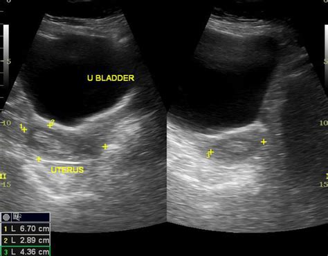 Endometrial hyperplasia ultrasound - wikidoc