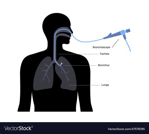 Bronchoscopy procedure concept Royalty Free Vector Image