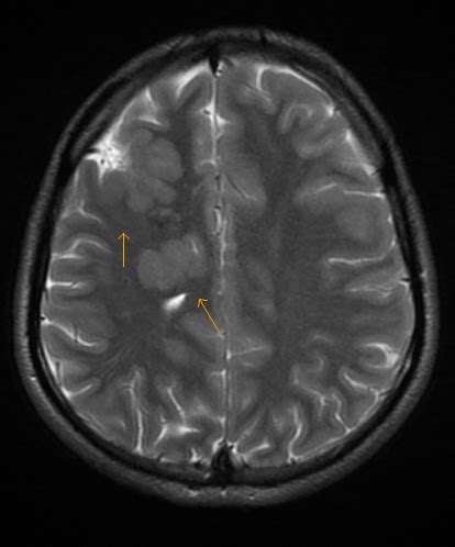 Grey matter heterotopia-MRI - Sumer's Radiology Blog