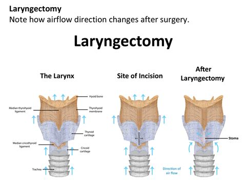 Laryngectomy Anatomy