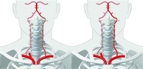 Endovascular treatment of tandem occlusions in vertebrobasilar stroke ...