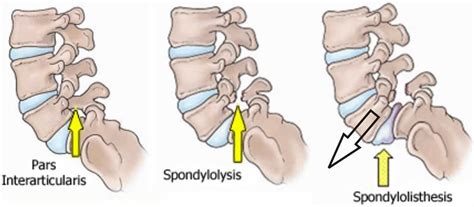 Spondylolisthesis causes, symptoms, diagnosis, grades, treatment ...