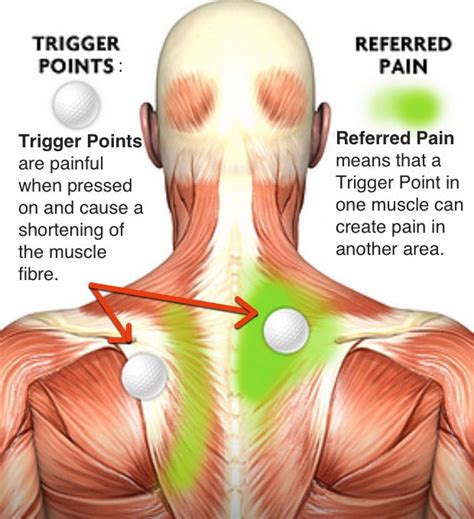 Trapezius Trigger Points Referred Pain