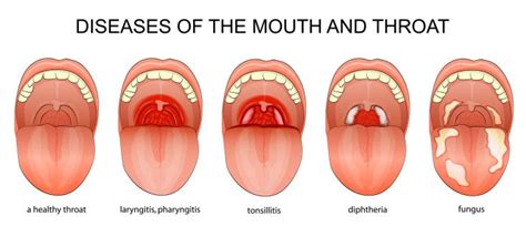 Diphtherie Symptome - Danette Akins