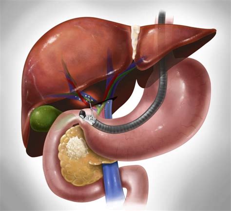 Endoscopic Ultrasound (EUS) – Dr. Indraneel Chakrabarty, MD