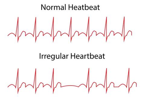 Heart Arrhythmias – Types, Causes and Prevention | Healthtian