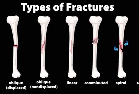 Types of Fractures - The Things You Need To Know | OPA