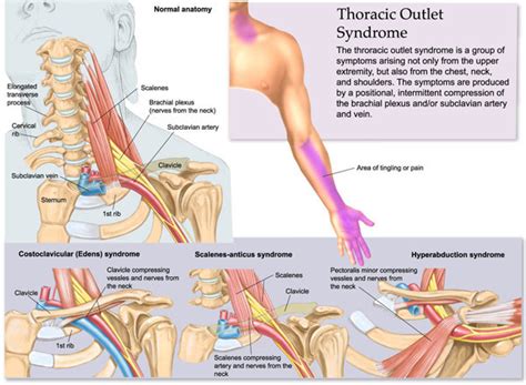 Thoracic Outlet Surgery In St Louis and Its Treatment - Neuropax Clinic ...