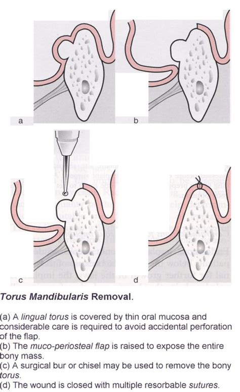 Removal of Tori – Exodontia