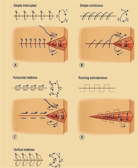 Different Types Of Surgical Suture Diagram