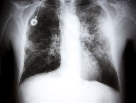 Asbestos Lung Cancer: Guide to Lung Cancer Caused by Asbestos