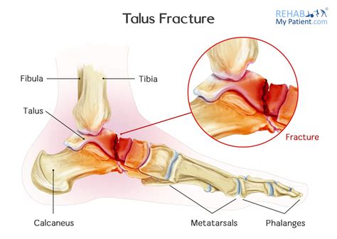 Talus Contusion