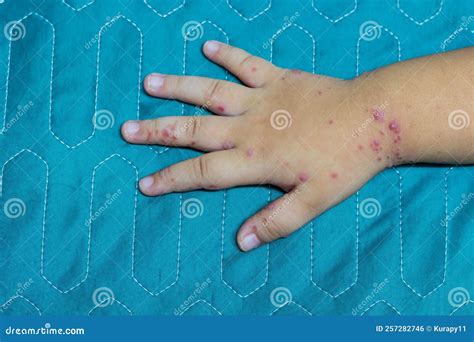 Enterovirus Leg Arm Mouth Rash on the Body of Child Cocksackie Virus ...