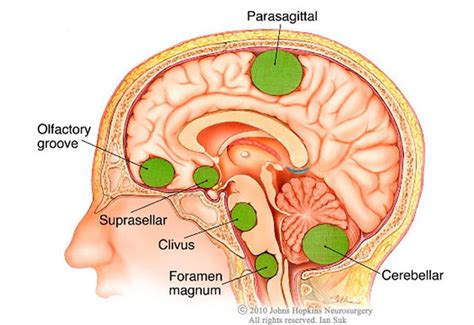 The Most Common Brain Tumor: 5 Things You Should Know | Johns Hopkins ...