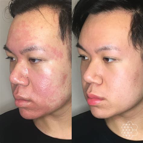 Acne Scar Treatment & Removal Vancouver BC | Skin Technique