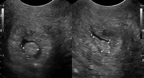 Cervical polyp - Wikipedia