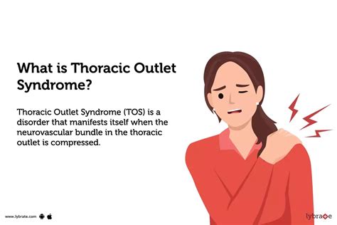 Thoracic Outlet Syndrome: Causes, Symptoms, Treatment and Cost