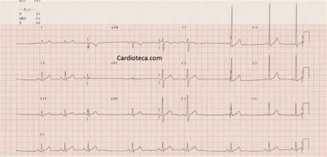 Curso ECG: Arritmia sinusal respiratoria