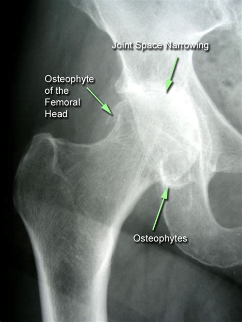 Hip Osteoarthritis - Recon - Orthobullets