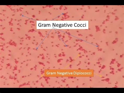 Gram Negative Diplococci In Sputum