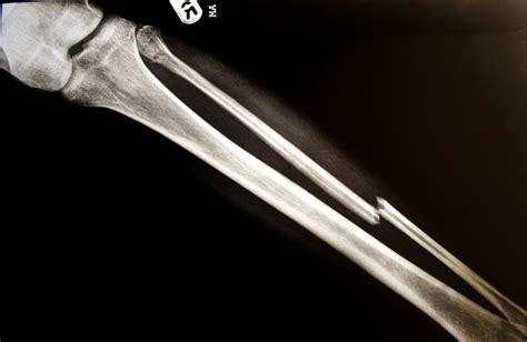 Broken Leg Bone X Ray