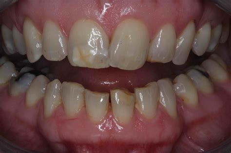 stained front tooth bonding procedure before