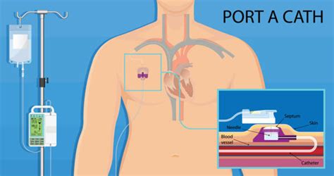 Hickman Catheter Vs Picc Line