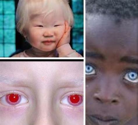 What Color Are Albino Human Eyes