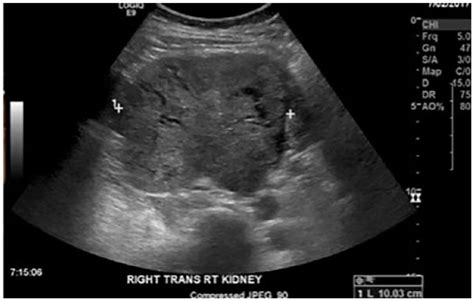 Sonographic Evaluation of Clear Cell Renal Cell Carcinoma - Emily Rail ...